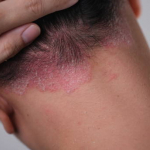 Psoriasi, Takeda annuncia risultati positivi per zasocitinib: la pillola sviluppata con supporto dell�AI supera Sotyktu in uno studio testa-a-testa